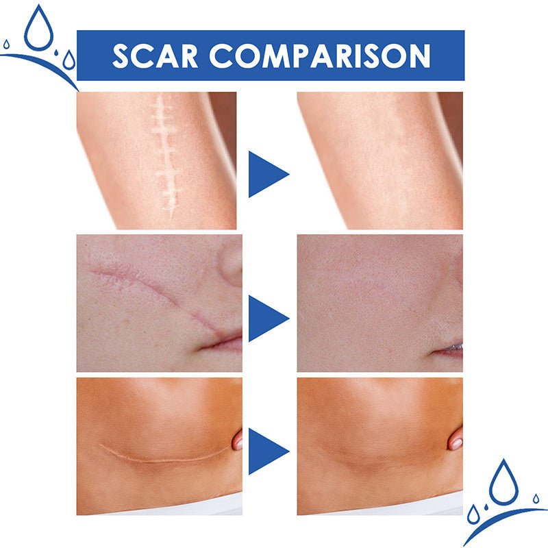 🏆50% OFF💥Say Goodbye to Scars in 4 Weeks — Clinically Proven Medical-Grade Formula